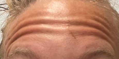 forehead-1-before