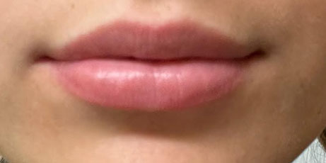 lip-filler-after