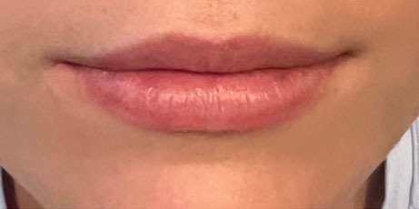 lip-filler-before